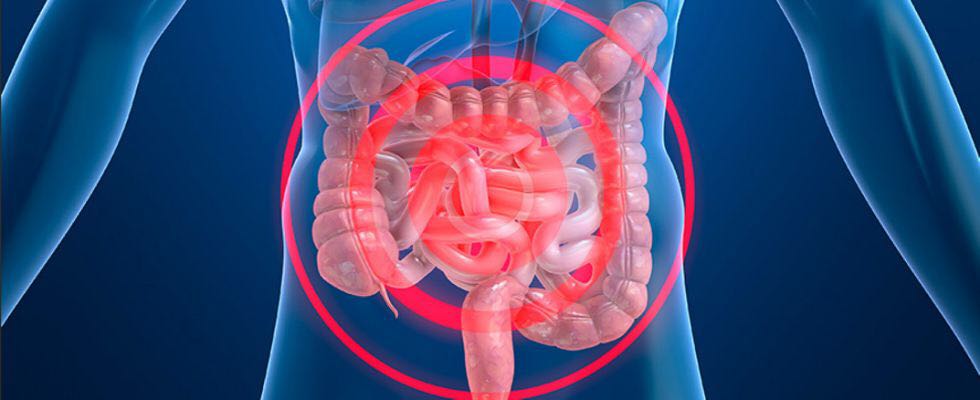 LA ENFERMEDAD INFLAMATORIA INTESTINAL